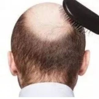 一图丨大量掉头发是脱发的前兆吗？答案扎心了