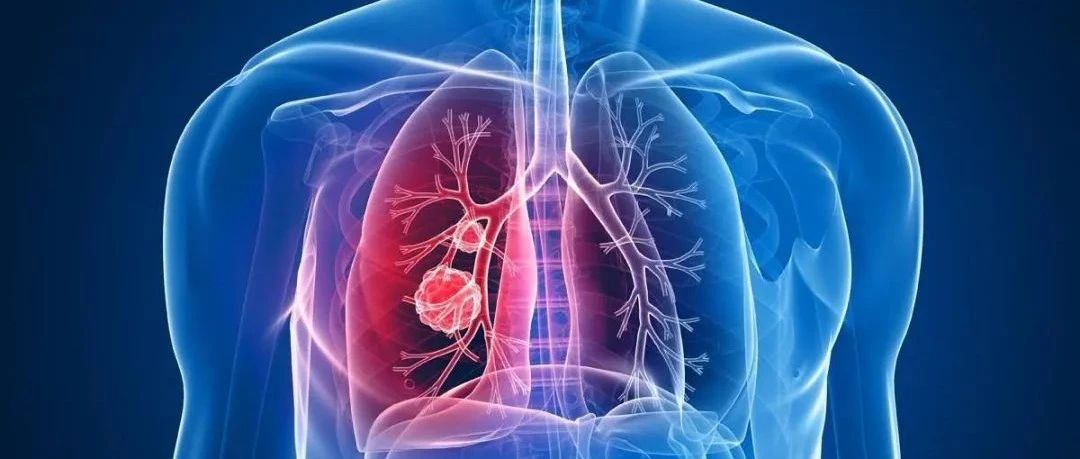 中康医药行研 | 大癌种系列肺癌治疗药物市场分析报告