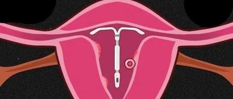 曼月乐环：我是一只避孕环，还可治疗多种妇科病