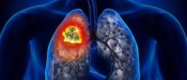 发现肺癌下一步该做什么？