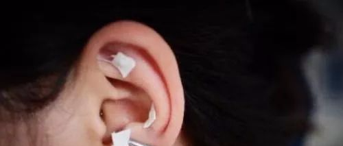 中医护理技术耳穴贴压（附操作视频）